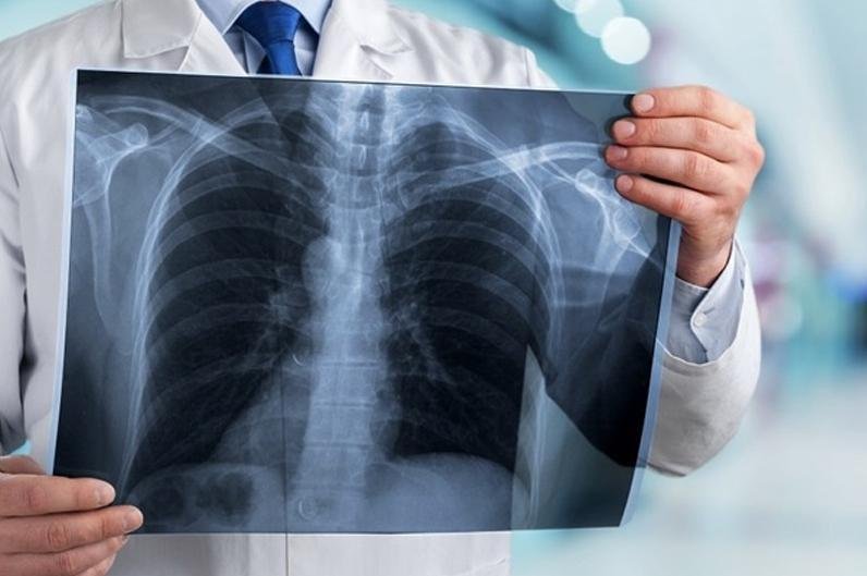 COVID-19-like pneumonia: 27 new cases, 2 victims